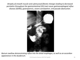 Atrophy of smooth muscle and submucosal fibrotic changes leading to decreased 
peristalsis throughout the gastrointestinal (GI) tract cause gastroesophageal reflux 
disease [GERD], gastroparesis, severe constipation, and pseudo-obstruction. 
Barium swallow demonstrating reflux into the distal esophagus, as well as an accordion 
appearance in the duodenum. 
Prof Ariyanto Harsono MD PhD SpA(K) 36 
 