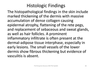 Histologic Findings 
The histopathological findings in the skin include 
marked thickening of the dermis with massive 
accumulation of dense collagen causing 
epidermal atrophy, flattening of the rete pegs, 
and replacement of sebaceous and sweat glands, 
as well as hair follicles. A prominent 
inflammatory infiltrate is often present at the 
dermal-adipose tissue interphase, especially in 
early lesions. The small vessels of the lower 
dermis show fibrous thickening but evidence of 
vasculitis is absent. 
Prof Ariyanto Harsono MD PhD SpA(K) 38 
 