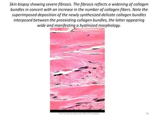 Skin biopsy showing severe fibrosis. The fibrosis reflects a widening of collagen 
bundles in concert with an increase in the number of collagen fibers. Note the 
superimposed deposition of the newly synthesized delicate collagen bundles 
interposed between the preexisting collagen bundles, the latter appearing 
wide and manifesting a hyalinized morphology. 
Prof Ariyanto Harsono MD PhD SpA(K) 39 
 