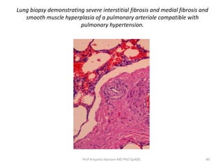 Lung biopsy demonstrating severe interstitial fibrosis and medial fibrosis and 
smooth muscle hyperplasia of a pulmonary arteriole compatible with 
pulmonary hypertension. 
Prof Ariyanto Harsono MD PhD SpA(K) 40 
 
