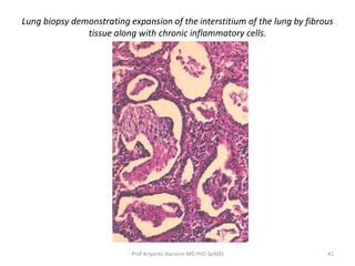 Lung biopsy demonstrating expansion of the interstitium of the lung by fibrous 
tissue along with chronic inflammatory cells. 
Prof Ariyanto Harsono MD PhD SpA(K) 41 
 
