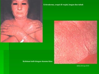 Sl erupsi akibat obat | PPT
