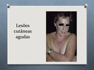 LesõesLesões
cutâneascutâneas
agudasagudas
 