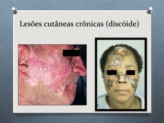Lesões cutâneas crônicas (discóide)Lesões cutâneas crônicas (discóide)
 