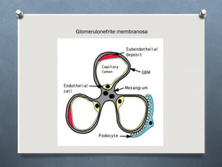 Glomerulonefrite membranosaGlomerulonefrite membranosa
 