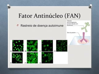 Fator Antinúcleo (FAN)
O Rastreio de doença autoimune
 