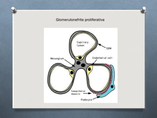 Glomerulonefrite proliferativaGlomerulonefrite proliferativa
 