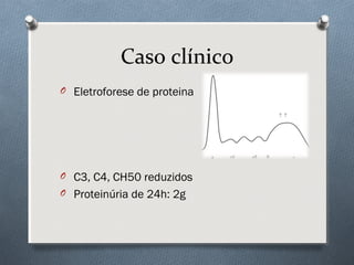 O Eletroforese de proteina
O C3, C4, CH50 reduzidos
O Proteinúria de 24h: 2g
Caso clínico
 