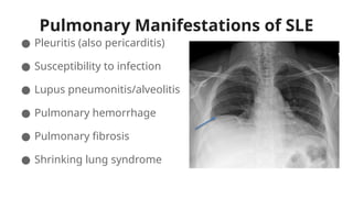 Pulmonary Manifestations of SLE
● Pleuritis (also pericarditis)
● Susceptibility to infection
● Lupus pneumonitis/alveolitis
● Pulmonary hemorrhage
● Pulmonary fibrosis
● Shrinking lung syndrome
 