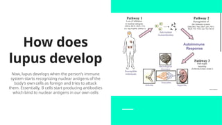 How does
lupus develop
Now, lupus develops when the person’s immune
system starts recognizing nuclear antigens of the
body’s own cells as foreign and tries to attack
them. Essentially, B cells start producing antibodies
which bind to nuclear antigens in our own cells
 
