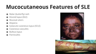 Mucocutaneous Features of SLE
● Malar (butterfly) rash
● Discoid lupus (DLE)
● Mucosal ulcers
● Alopecia
● Subacute cutaneous lupus (SCLE)
● Cutaneous vasculitis
● Bullous lupus
● Panniculitis
 