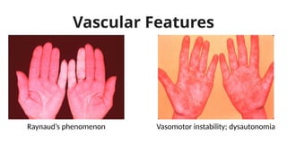 Vascular Features
Vasomotor instability; dysautonomia
Raynaud’s phenomenon
 