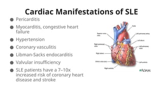 Cardiac Manifestations of SLE
● Pericarditis
● Myocarditis, congestive heart
failure
● Hypertension
● Coronary vasculitis
● Libman-Sacks endocarditis
● Valvular insufficiency
● SLE patients have a 7–10x
increased risk of coronary heart
disease and stroke
 