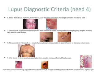 Lupus Diagnostic Criteria (need 4)
 1. Malar Rash: Fixed erythema, flat or raised, over the malar eminences, tending to spare the nasolabial folds
 2. Discoid rash: Erythematous raised patches with adherent keratotic scaling and follicular plugging; atrophic scarring
may occur in older lesions
 3. Photosensitivity: Skin rash as a result of unusual reaction to sunlight, by patient history or physician observation
 4. Oral ulcers: Oral or nasopharyngeal ulceration, usually painless, observed by physician
From http://www.rheumatology.org/publications/classification/SLE/1997UpdateOf1982RevisedCriteriaClassificationSLE.asp?aud=pat
 