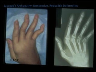 Jaccoud’s Arthopathy: Nonerosive, Reducible Deformities
 