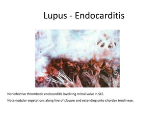 Lupus - Endocarditis
Noninfective thrombotic endocarditis involving mitral valve in SLE.
Note nodular vegetations along line of closure and extending onto chordae tendineae.
 