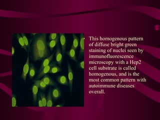 Sle Patterns systemic lupus erythematosus | PPT