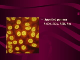 Sle Patterns systemic lupus erythematosus | PPT