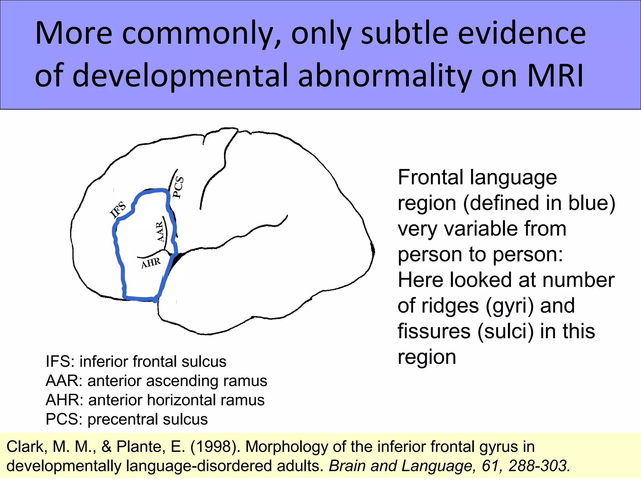 More commonly, only subtle evidence
   of developmental abnormality on MRI

                                                      Frontal language
                                                      region (defined in blue)
                                                      very variable from
                                                      person to person:
                                                      Here looked at number
                                                      of ridges (gyri) and
                                                      fissures (sulci) in this
     IFS: inferior frontal sulcus                     region
     AAR: anterior ascending ramus
     AHR: anterior horizontal ramus
     PCS: precentral sulcus
Clark, M. M., & Plante, E. (1998). Morphology of the inferior frontal gyrus in
developmentally language-disordered adults. Brain and Language, 61, 288-303.
 