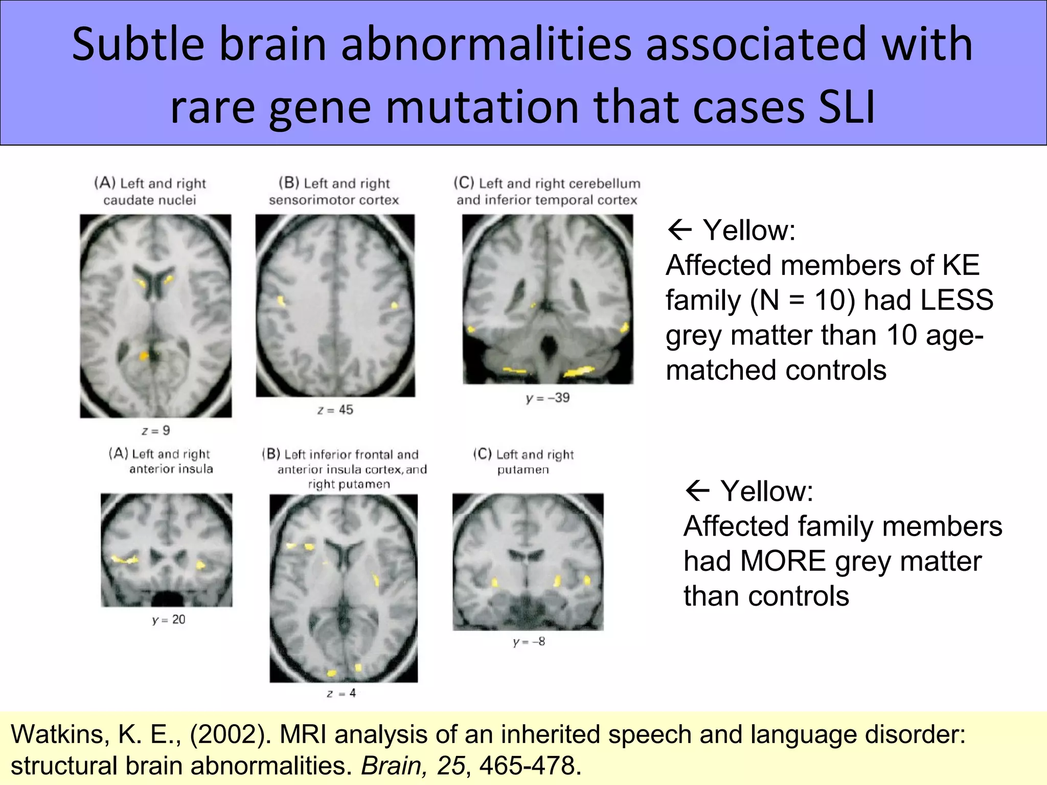 Subtle brain abnormalities associated with
         rare gene mutation that cases SLI

                                                         Yellow:
                                                        Affected members of KE
                                                        family (N = 10) had LESS
                                                        grey matter than 10 age-
                                                        matched controls



                                                          Yellow:
                                                         Affected family members
                                                         had MORE grey matter
                                                         than controls



Watkins, K. E., (2002). MRI analysis of an inherited speech and language disorder:
structural brain abnormalities. Brain, 25, 465-478.
 