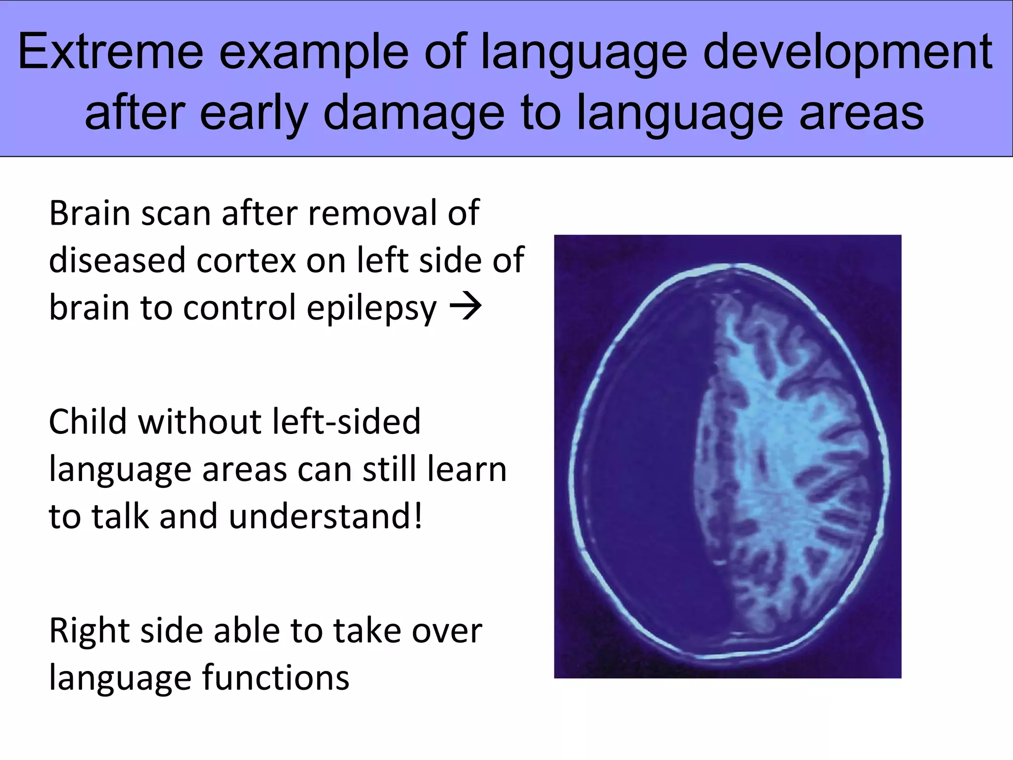 Extreme example of language development
   after early damage to language areas
 Brain scan after removal of
 diseased cortex on left side of
 brain to control epilepsy 

 Child without left-sided
 language areas can still learn
 to talk and understand!

 Right side able to take over
 language functions
 