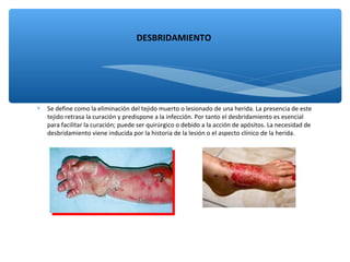 ∗ Se define como la eliminación del tejido muerto o lesionado de una herida. La presencia de este
tejido retrasa la curación y predispone a la infección. Por tanto el desbridamiento es esencial
para facilitar la curación; puede ser quirúrgico o debido a la acción de apósitos. La necesidad de
desbridamiento viene inducida por la historia de la lesión o el aspecto clínico de la herida.
DESBRIDAMIENTO
 