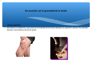 ∗ Herida superficial
∗ Solo afecta a la epidermis, cuya causa es el resultado de la fricción aplicada a la superficie cutánea. Por ejemplo
abrasión o quemaduras de primer grado.
De acuerdo con la gravedad de la lesión
 