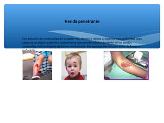 ∗ Con solución de continuidad de la epidermis, dermis y tejidos u órganos más profundos cuya
causa es un objeto extraño o instrumento que penetra profundamente en los tejidos
corporales, habitualmente de forma involuntaria. Por ejemplo heridas por arma de fuego o
puñaladas.
Herida penetrante
 