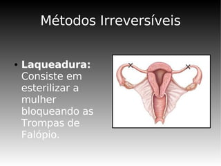 Métodos Irreversíveis


●   Laqueadura:
    Consiste em
    esterilizar a
    mulher
    bloqueando as
    Trompas de
    Falópio.
 