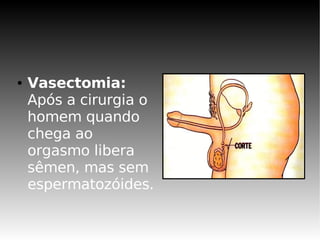 ●   Vasectomia:
    Após a cirurgia o
    homem quando
    chega ao
    orgasmo libera
    sêmen, mas sem
    espermatozóides.
 