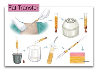 20150205 Anti-Aging & Fat Grafting Speech