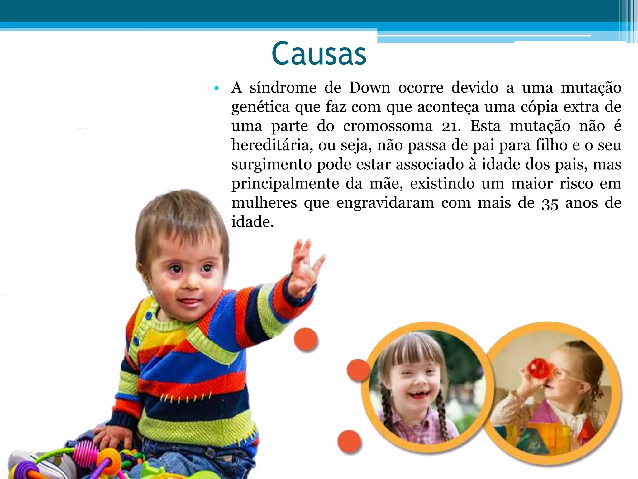 Slide -Sindrome de Down | PPTX