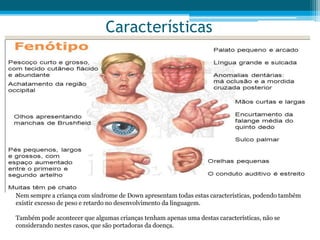 Características
Nem sempre a criança com síndrome de Down apresentam todas estas características, podendo também
existir excesso de peso e retardo no desenvolvimento da linguagem.
Também pode acontecer que algumas crianças tenham apenas uma destas características, não se
considerando nestes casos, que são portadoras da doença.
 