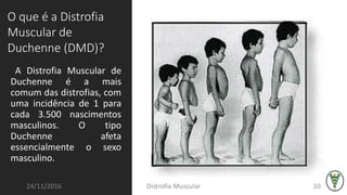 A Distrofia Muscular de
Duchenne é a mais
comum das distrofias, com
uma incidência de 1 para
cada 3.500 nascimentos
masculinos. O tipo
Duchenne afeta
essencialmente o sexo
masculino.
24/11/2016 Distrofia Muscular 10
O que é a Distrofia
Muscular de
Duchenne (DMD)?
 