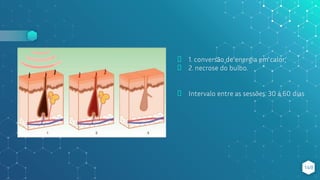 ⬥ 1. conversão de energia em calor;
⬥ 2. necrose do bulbo.
⬥ Intervalo entre as sessões: 30 à 60 dias
149
 
