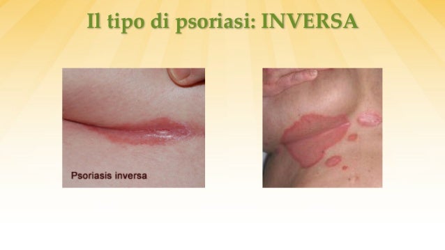 Eczema con bolle sulle dita di mani