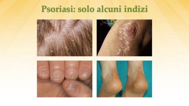 Come psoriasi sui piaceri di rimedi di gente principali