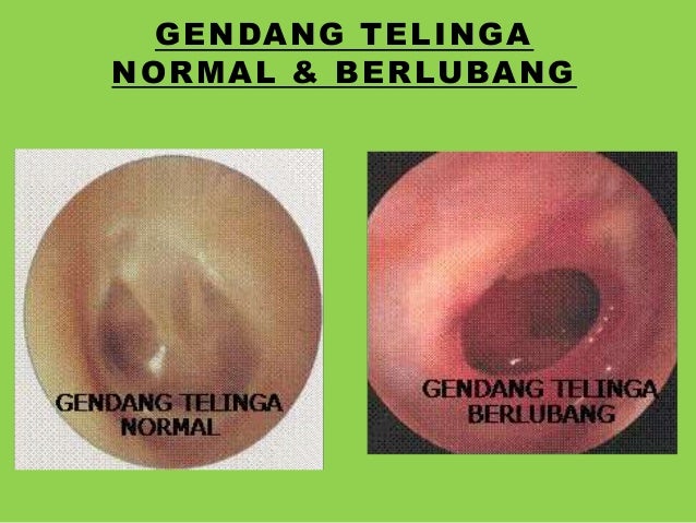 Download 900 Koleksi Gambar Gendang Telinga Normal  HD