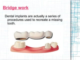 Bridge work 
Dental implants are actually a series of 
procedures used to recreate a missing 
tooth. 
 