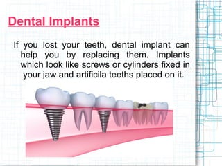 Dental Implants 
If you lost your teeth, dental implant can 
help you by replacing them. Implants 
which look like screws or cylinders fixed in 
your jaw and artificila teeths placed on it. 
 