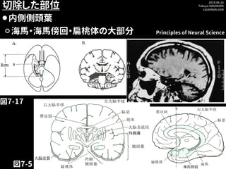 2019.06.26
Takuya KOUMURA
cycentum.com
切除した部位
⚫内側側頭葉
⚪海馬・海馬傍回・扁桃体の大部分
図7-17
Principles of Neural Science
図7-5
 
