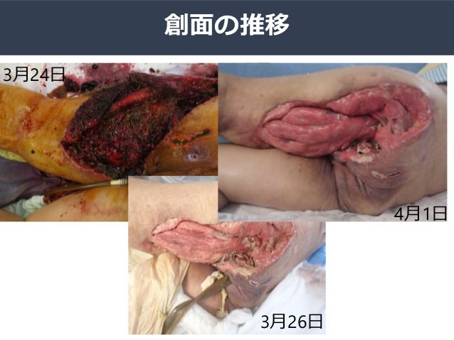 治療に難渋した壊死性筋膜炎の一例 治療に難渋した壊死性筋膜炎の一例