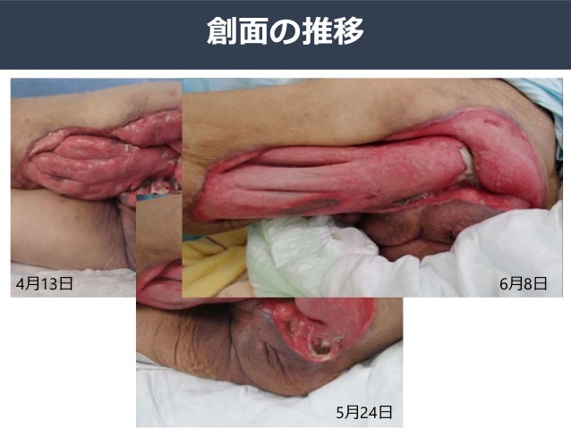 治療に難渋した壊死性筋膜炎の一例 治療に難渋した壊死性筋膜炎の一例