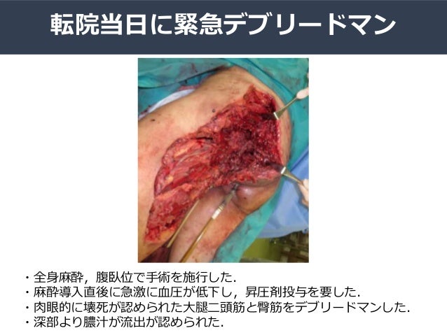 治療に難渋した壊死性筋膜炎の一例 治療に難渋した壊死性筋膜炎の一例