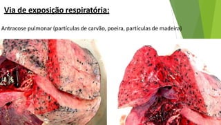 Antracose pulmonar (partículas de carvão, poeira, partículas de madeira)
Via de exposição respiratória:
 