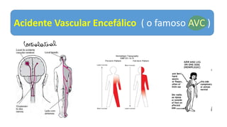 Acidente Vascular Encefálico ( o famoso AVC )
Contralatural
 