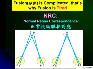 Fusion(融像) is Complicated, that’s
why Fusion is Tired
NRC:
Normal Retina Correspondence
正常視網膜相對應
 