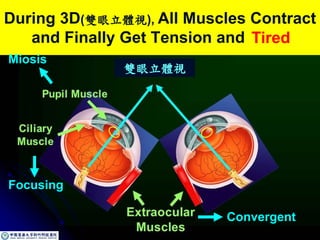 Pupil Muscle
Ciliary
Muscle
Extraocular
Muscles
During 3D(雙眼立體視), All Muscles Contract
and Finally Get Tension and Tired
Tired
Convergent
Focusing
Miosis
雙眼立體視
 