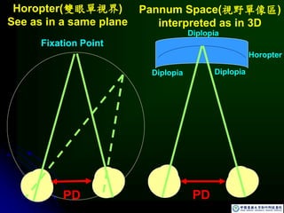 PD
Diplopia
Diplopia
Horopter
Diplopia
PD
Fixation Point
Pannum Space(視野單像區)
interpreted as in 3D
Horopter(雙眼單視界)
See as in a same plane
 