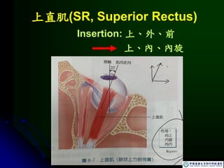 上直肌(SR, Superior Rectus)
Insertion: 上、外、前
上、內、內旋
 